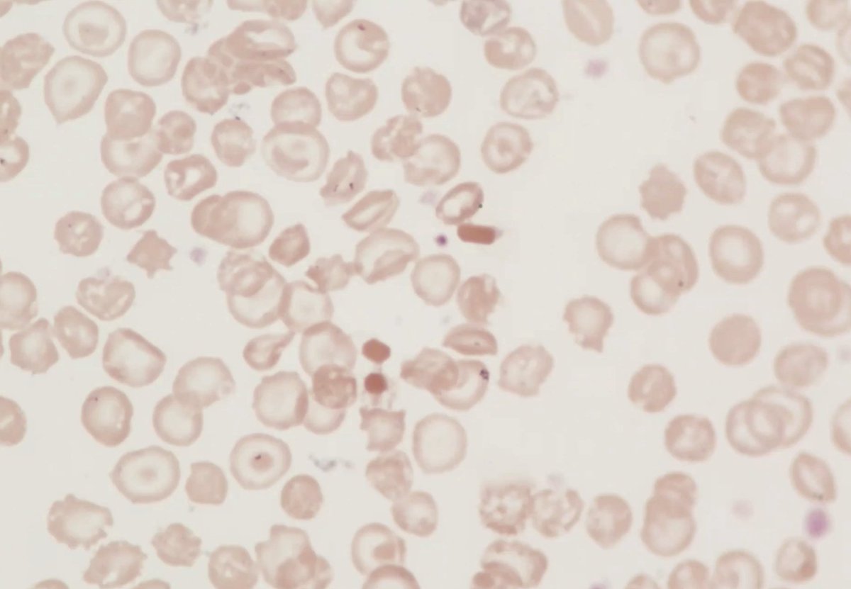 Peripheral Blood Smear🔽🔽 
Parents: ♂️ is from 🇬🇭and ♀️is from 🇮🇹
Describe the features on this film
Thoughts🧌
#morphologymonday #MedTwitter #MedEd #hematology #blooducation