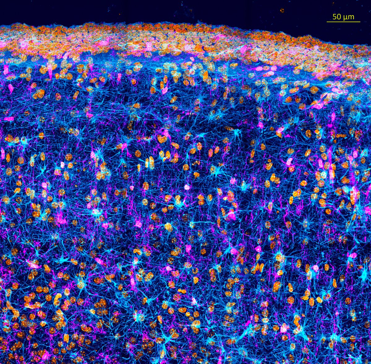 Happy #MicroscopyMonday 👻! The image below shows glial cells occupying the lateral ventricle wall of the brain🧠. Markers: 🟠Dapi 🩷Microglia (iba1), 🔵Astrocytes (gfap).