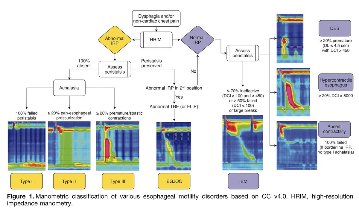 sepdigestiva's tweet photo. Esophageal Motility Disorders: Current Approach to Diagnostics and Therapeutics by @EsophagusDoc

Great review @AGA_Gastro @AmerGastroAssn
 
#GITwitter #MedTwitter 

https://t.co/iaVz0b9wb0 https://t.co/pCh4aMjpnc
