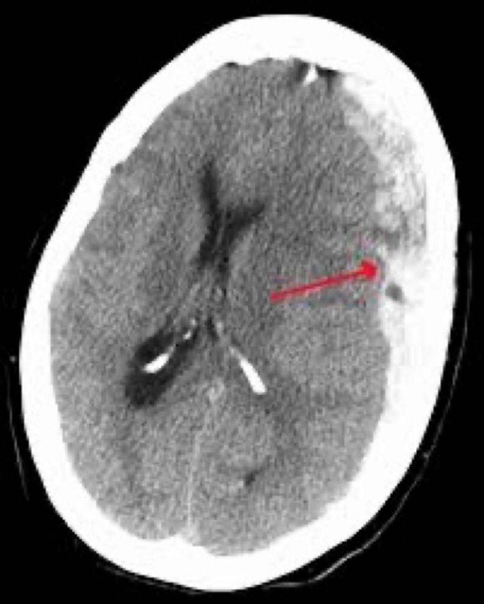 BrownJHM's tweet image. A patient presented to the hospital following a motor vehicle accident. A CT brain was done. What is the likely diagnosis? (image: Wikipedia) #FOAMcc
