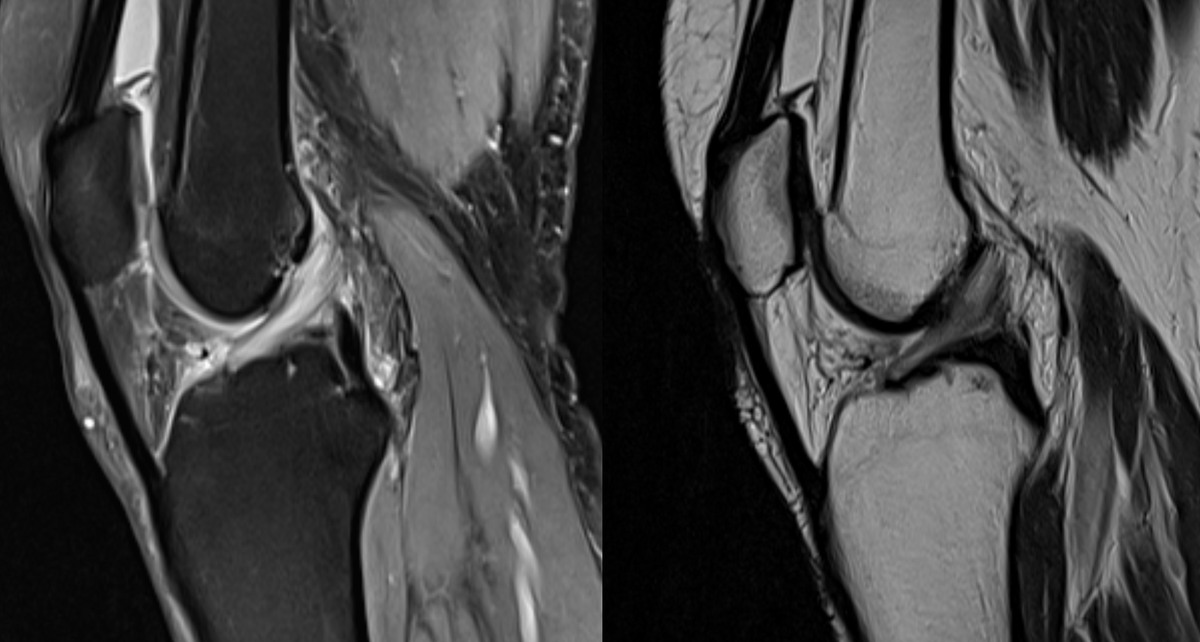 Sagittal PD fat sat and T2w MRI demonstrating mucoid degeneration of anterior cruciate ligament - celery stalk. #foamed #foamrad #elearnrad #drbabu #rad #radres #kuwait #medtwitter #msk #mri #ortho #mskrad