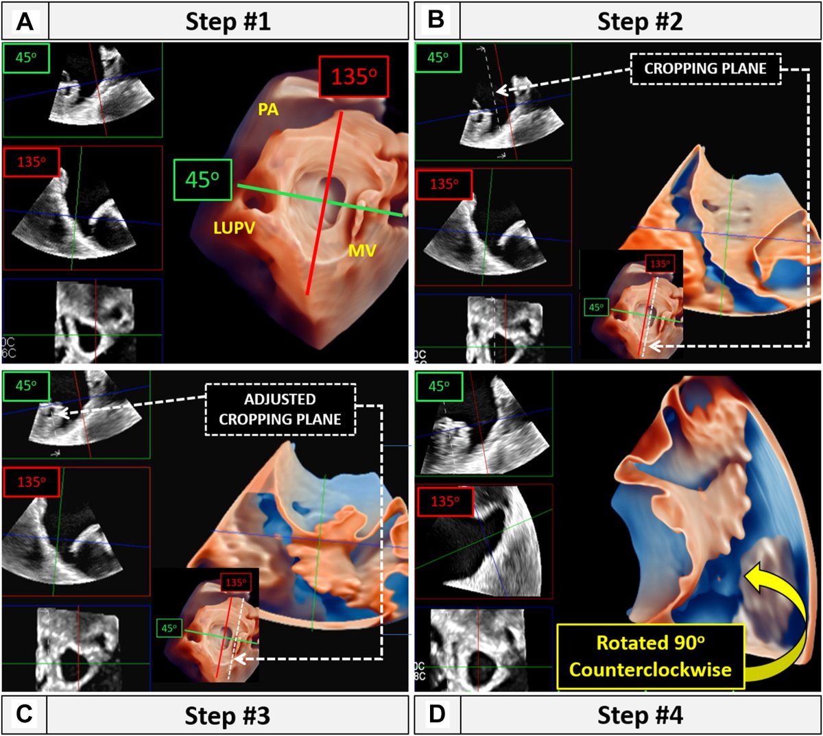 American Society of Echocardiography (@ase360) on Twitter photo We have developed a simplified version of the below 3D TEE maneuver, which minimizes the number of image rotation and cropping steps.
We have termed this simplified version the 3D left atrial appendage (LAA) multiview (LAAM) technique. bit.ly/46LIIMO <a href="/CASEfromASE/">CV Case Journal</a> We have developed a simplified version of the below 3D TEE maneuver, which minimizes the number of image rotation and cropping steps.
We have termed this simplified version the 3D left atrial appendage (LAA) multiview (LAAM) technique. bit.ly/46LIIMO <a href="/CASEfromASE/">CV Case Journal</a>