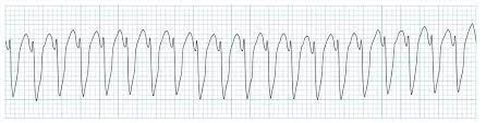 1. A 40-year-old man presents to the emergency room with episodes of weakness and paralysis. Initial labs show a K of 1.0 meQ/L. Shortly after he goes into ventricular tachycardia… What is going on?