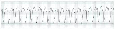 1. A 40-year-old man presents to the emergency room with episodes of weakness and paralysis.

Initial labs show a K of 1.0 meQ/L. Shortly after he goes into ventricular tachycardia…

What is going on?