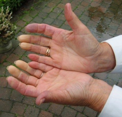 Vínculos genéticos para Raynauds Phen