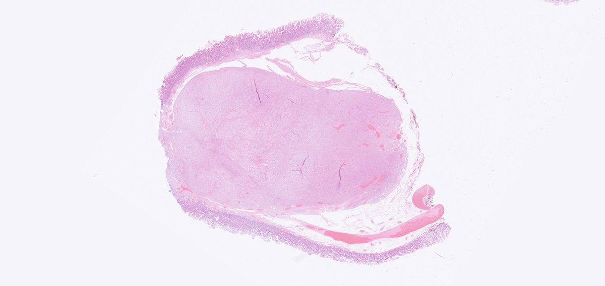 DrJuhlin's tweet photo. Endoscopic mucosal resection of a 14 mm duodenal  lesion. Low power overview. Submucosal tumor without association to the epithelium. 

Let's have a closer look! (thread) https://t.co/LVyd5C5RXG