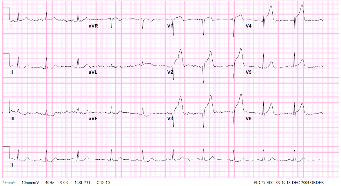 IhabFathiSulima's tweet photo. 45 Male with severe Retrosternal #Chest_Pain.
What is the #Rhythm ?
What is the diagnosis ? https://t.co/xZOwTvThC8
