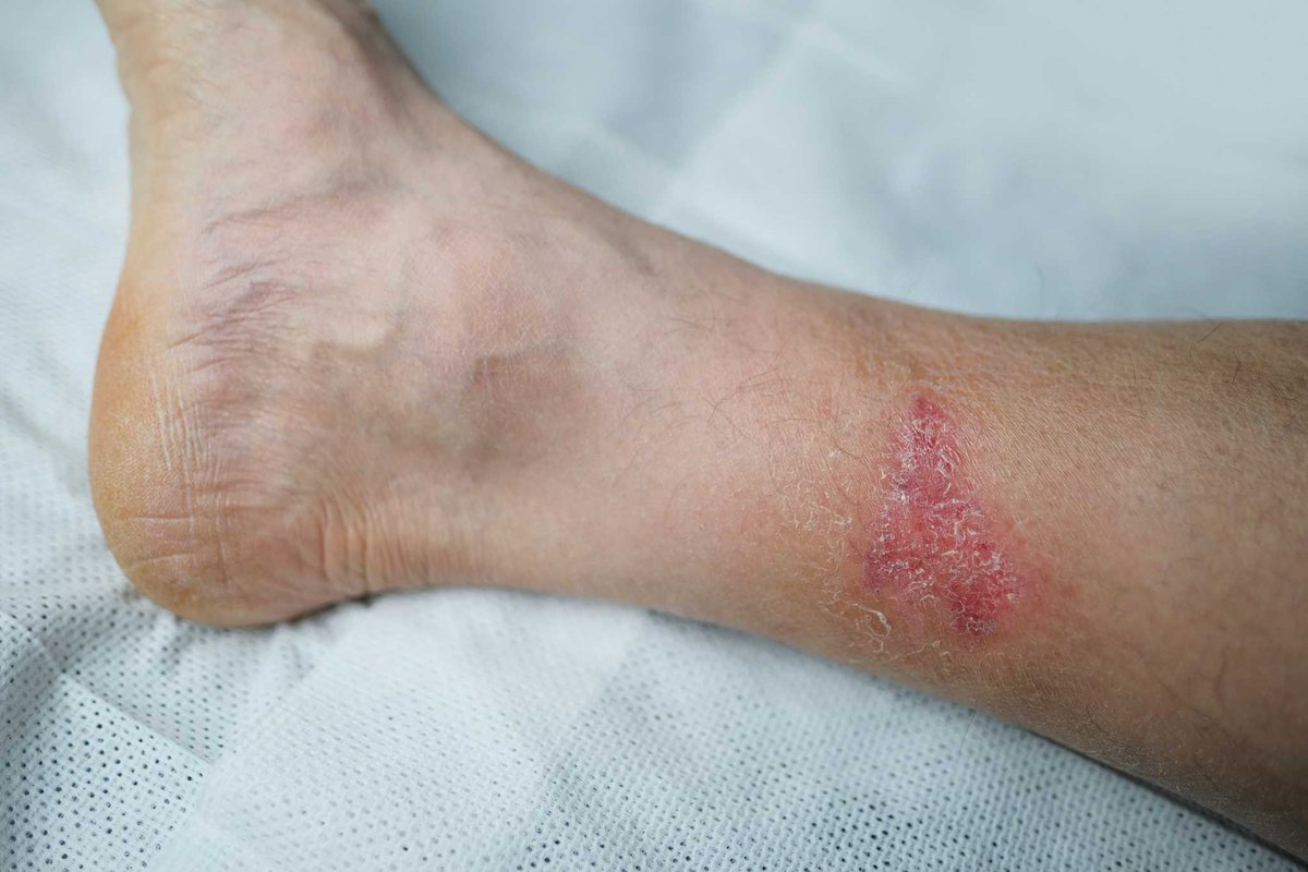 BurlingtonFoot's tweet photo. Don't overlook your foot health if you have diabetes. Trust the experienced team at Burlington County Foot &amp; Ankle Associates for comprehensive #DiabeticFootCare. #FootCare
https://t.co/fzQMnYNLy7 https://t.co/YqkyQDB1kj