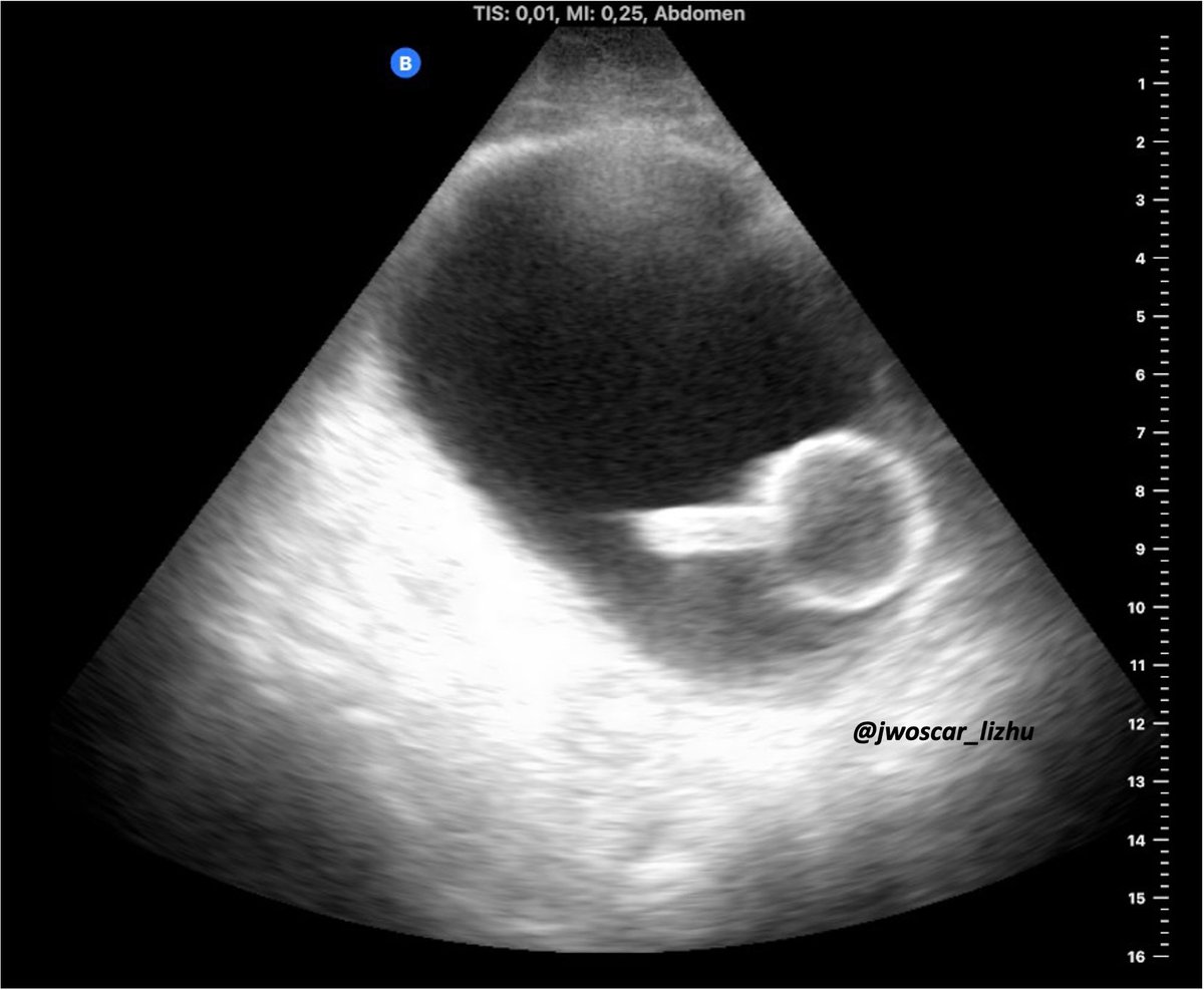 jwoscar_lizhu's tweet photo. Lecciones de guardia: Que un paciente esté sondado, no descarta una RAO. Para eso está #POCUS y la solución es sencilla. https://t.co/v8HAmc9PAx
