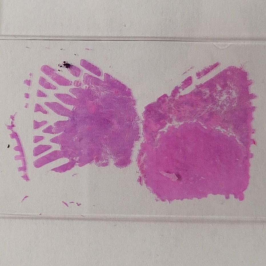 leon_metlay's tweet photo. This is the artifact caused by an #autoembedder. Our recent experience seems to indicate that #placentas are particularly susceptible to this. Maybe the villi ooze between the slats? If your lab uses an autoembed, what types of specimens do you see this in? #pathology https://t.co/4IzzZISU4Q