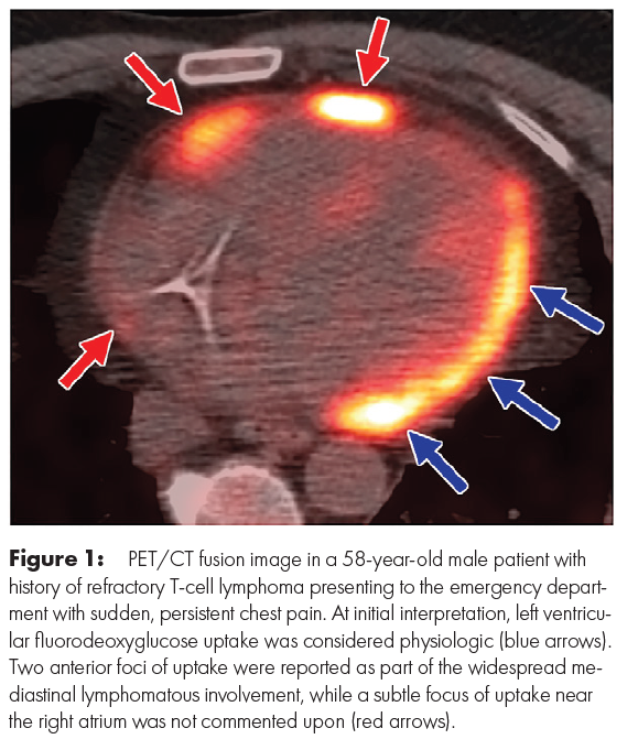 Catch up on the latest from #ImagesinCancer in Radiology: Imaging Cancer. 'Improved Visualization of Lymphomatous Cardiac Involvement with Retrospective PET/MRI Fusion' by Hunter et al. Full Article: doi.org/10.1148/rycan.… @AmitGupta_83 @UHRadiology @luker_md @VivekKaliaMD