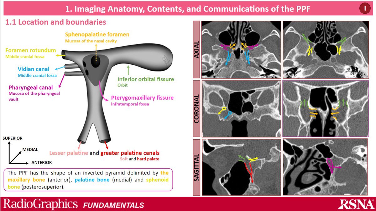 albasalpar's tweet photo. JUST RELEASED! 📚 Incredibly honored to present our latest publication in @Radiographics, exploring the Pterygopalatine Fossa and perineural spread. Check it out! 

➡️https://t.co/ZNydndp4V3

@RadG_Editor @ASHNRSociety @TheASNR @ESNRad @cookyscan1 #radres #neuroradiology #RSNA https://t.co/varFoM6pHp