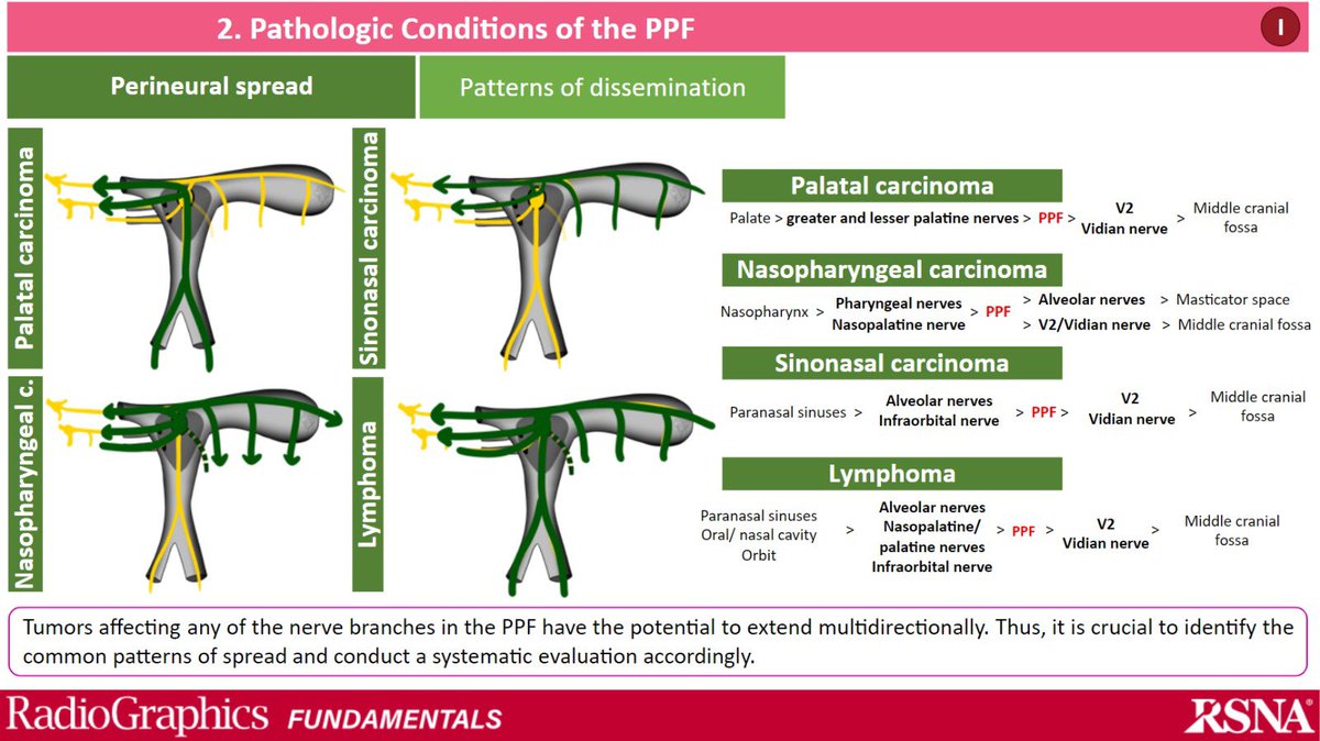 albasalpar's tweet photo. JUST RELEASED! 📚 Incredibly honored to present our latest publication in @Radiographics, exploring the Pterygopalatine Fossa and perineural spread. Check it out! 

➡️https://t.co/ZNydndp4V3

@RadG_Editor @ASHNRSociety @TheASNR @ESNRad @cookyscan1 #radres #neuroradiology #RSNA https://t.co/varFoM6pHp