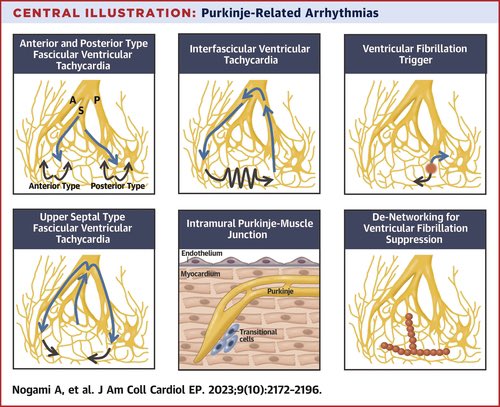 Ed_Alania's tweet photo. 🔴 Purkinje-Related Ventricular Tachycardia &amp; Ventricular Fibrillation: Solved &amp; Unsolved Questions @JACCJournals #cardioEd #Cardiology #Epeeps #FOAMed https://t.co/QPG2t1Vj69