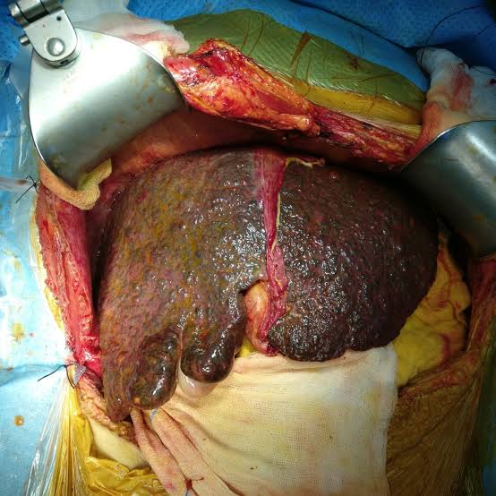 GYerathel's tweet photo. Alcoholic liver cirrhosis!!

Liver's are getting cooked daily from drinking self made fake alcohol such as Hennessey, Gordon's, Russian beer, belgravia, made by the foreign nationals.

So they are killing the country slowly but surely.

Some of you are coughing blood and having respiratory problems not because of TB but because of smoking fake self made vapes, fake hookah pipe flavours