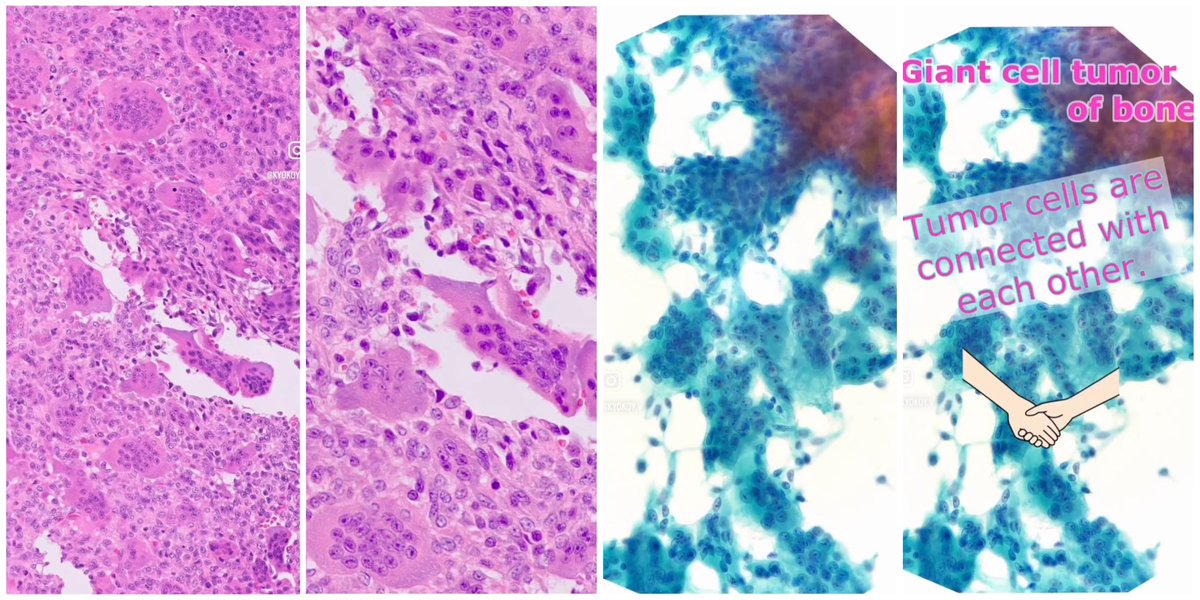 kyokoy_v's tweet photo. Giant cell tumor of bone. H3G34W+(IHC). The tumor is composed of oval to short-spindled neoplastic cells and osteoclast-type giant cells. [インスタのリール動画より]
#病理 #bstpath #細胞診 #histopathology #pathology #cytology #骨軟部細胞診 https://t.co/Xqnnwf2ZKl
