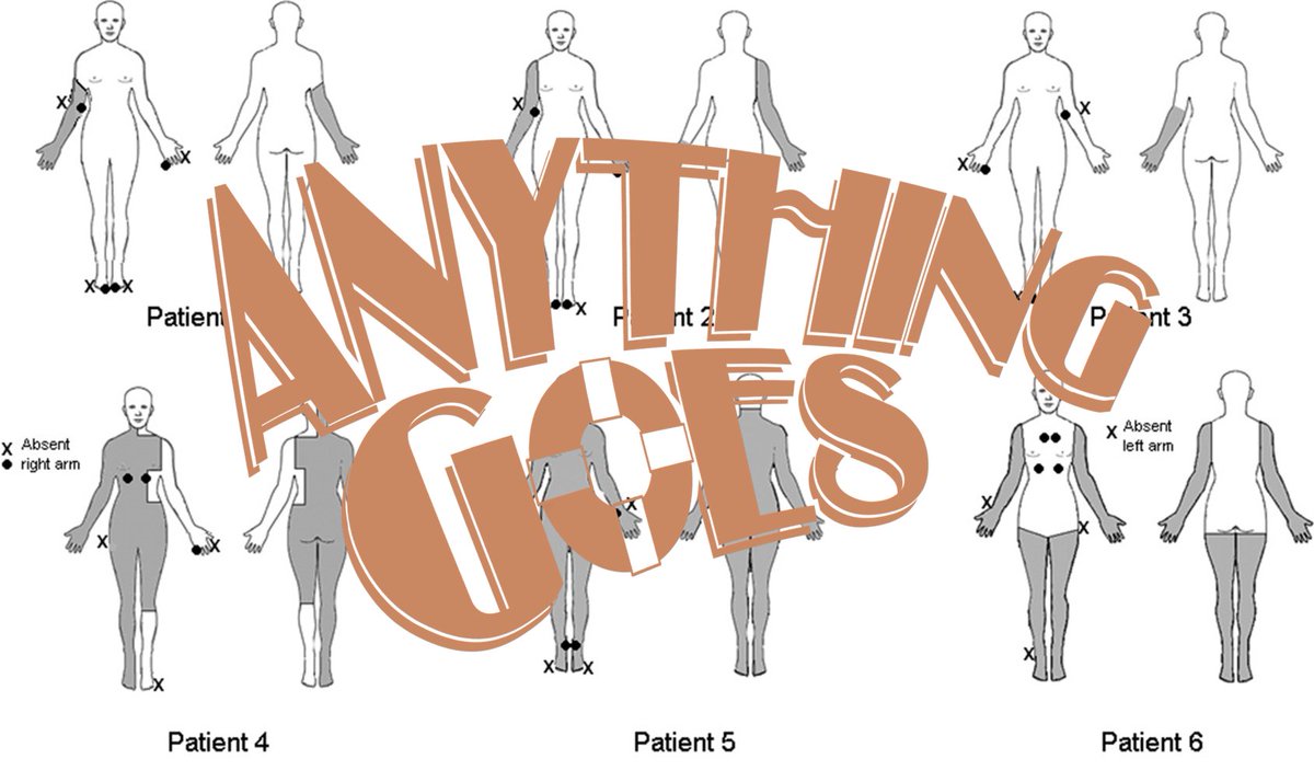 Saw another patient with sensory neuronopathy who had been misdiagnosed