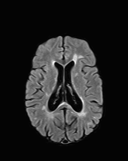 Last week’s MRI reports that my brain is “stable.” No new or active lesions (just what had already happened over the last 25+ years). 

NO ACTIVE DISEASE PROCESS!
#MultipleSclerosis #MSStrong #MS #Lemtrada