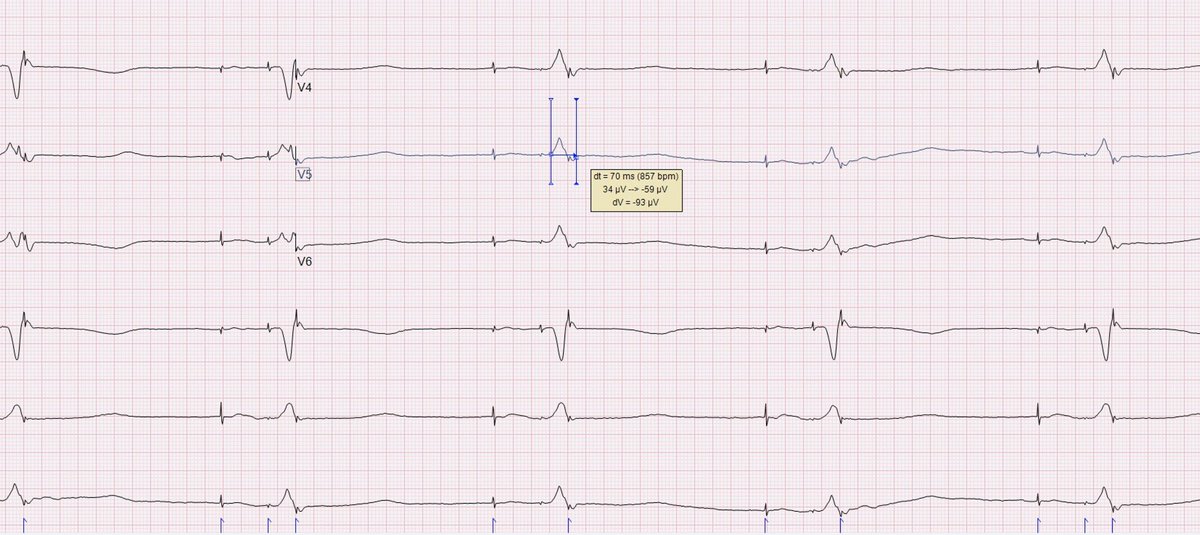 AV node ablation #dontdisthehis #LBBpacing #conductionsystempacing