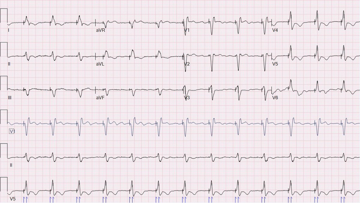 LV threshold was high at time of ICD generator change. Could not get new LV lead to good position. #LBBpacing looks better anyway #dontdisthehis #conductionsystempacing