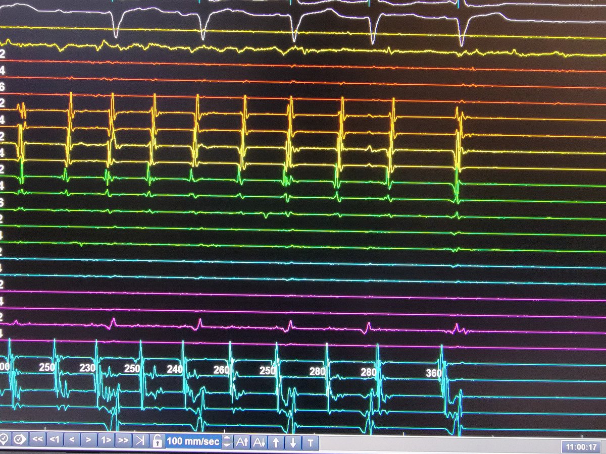 Alex Turin (@alexturinmd) on Twitter photo Redo AF case with excellent 1st year EP fellow <a href="/JasneetDevgun/">Jasneet Devgun</a>. Touch up PVI followed by AF termination with dispersion ablation on the LA roof. <a href="/UMichCardiology/">Michigan Cardiology</a> Redo AF case with excellent 1st year EP fellow <a href="/JasneetDevgun/">Jasneet Devgun</a>. Touch up PVI followed by AF termination with dispersion ablation on the LA roof. <a href="/UMichCardiology/">Michigan Cardiology</a>