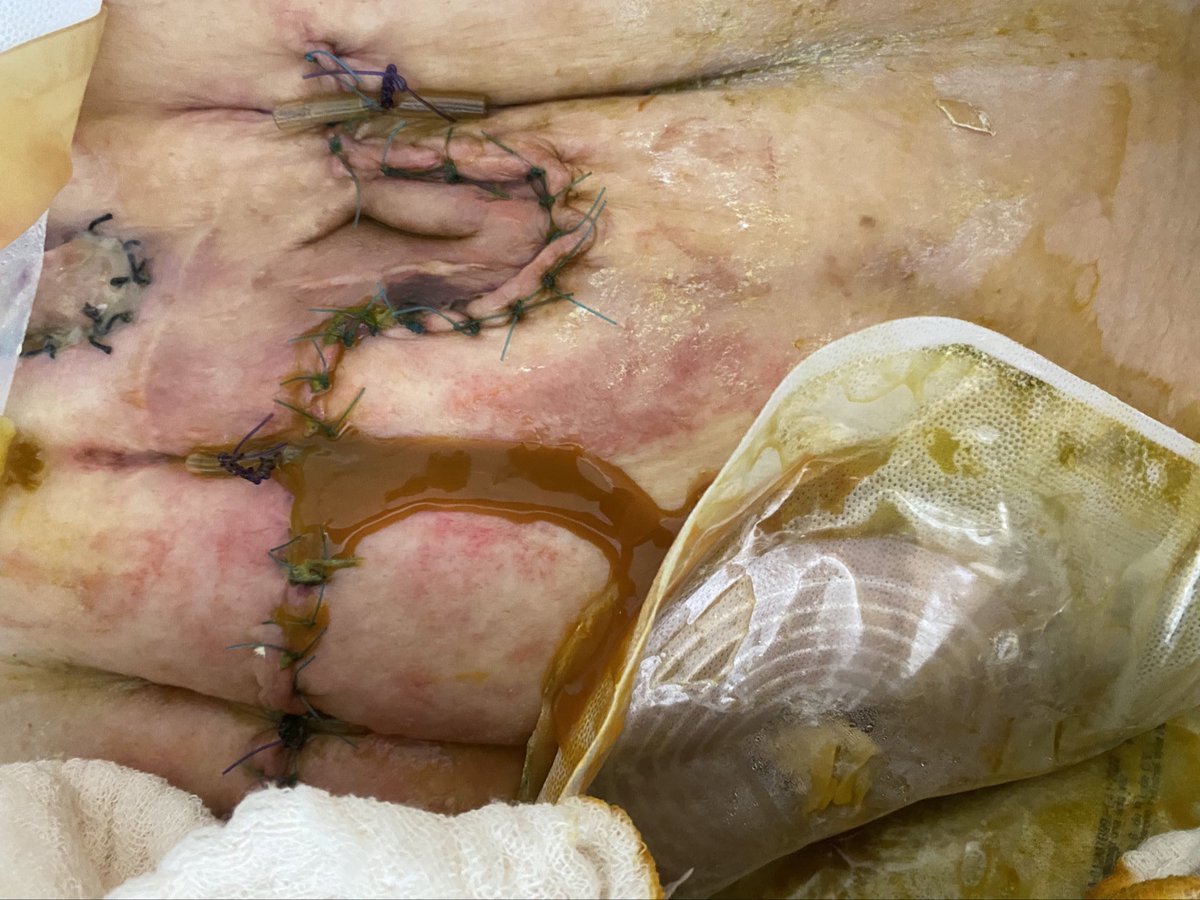 la eutanacia pasiva
(no hacer nada y solo esperar a k muerq)
es la mas inumana y kara para las insturiciones

cuanto puede costar este paciente a  esperar k muera
k tan humano es no hacer nada y esperar a k muera
la sepsis abdominal la peor forma de morir y la mas evitable