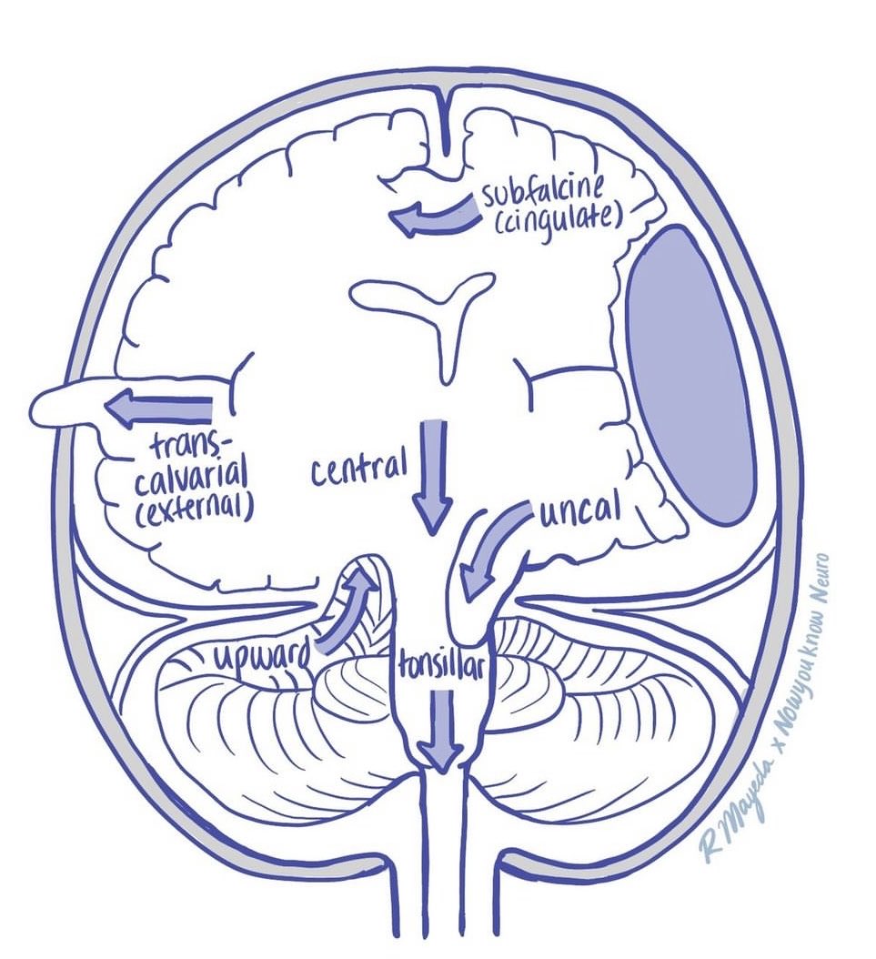 OGdukeneurosurg's tweet image. Intracranial pressure and herniation primer from now you know neuro