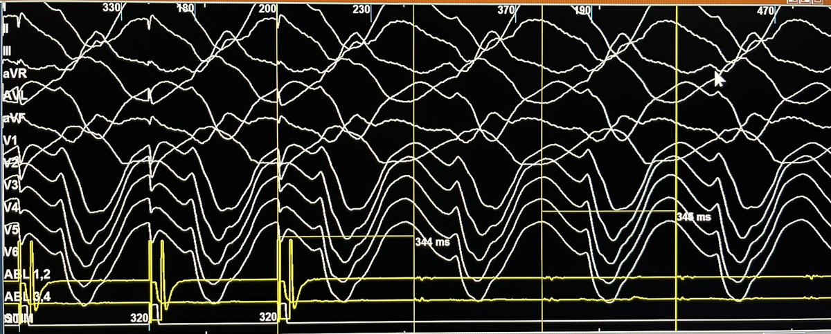 Entrainment of VT in a basal inferior scar #EPeeps