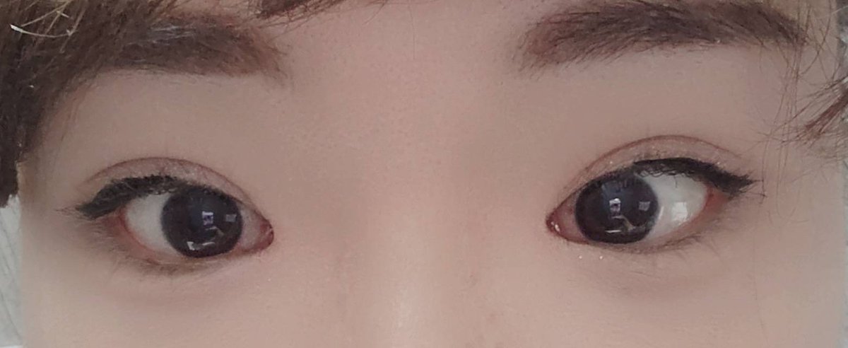 awt0728's tweet photo. 7/28に 二重切開+目頭切開+目付き矯正してほぼ3ヶ月目👀❤️
経過も順調で傷痕も全然目立たない😭💕
経過チェックもしっかり見てくれるし
本当にやってよかった‼️
#ビュー美容外科 https://t.co/ApMrgKadDK