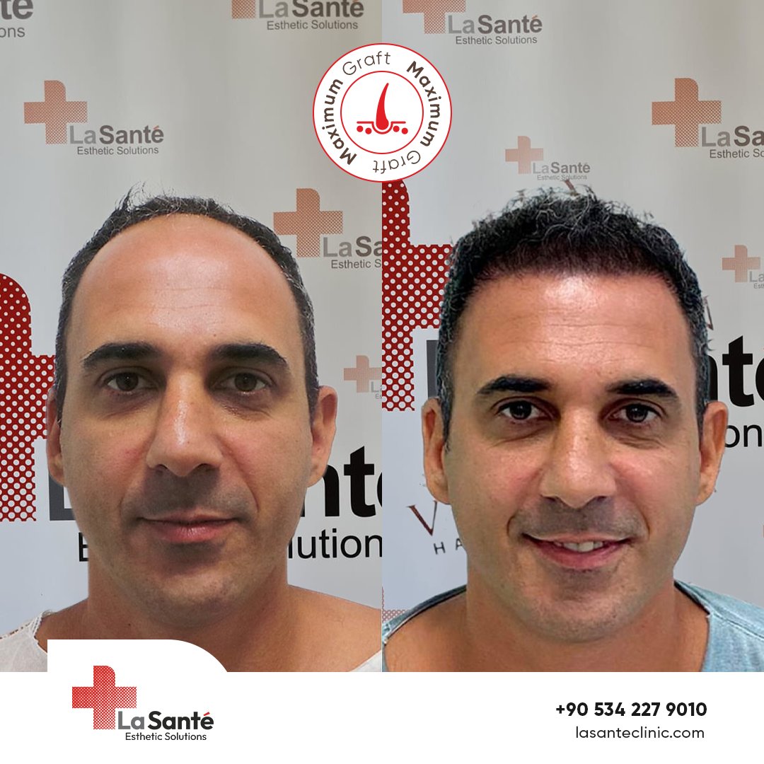 ✨ Elevate your hair transplant experience with our state-of-the-art methods.

For more information, contact us:

📞 +905342279010
📧 info@lasanteclinic.com
🌐 lasanteclinic.com

🌟 #HairSolutions #SolucionesCapilares #SoluzioniCapillari