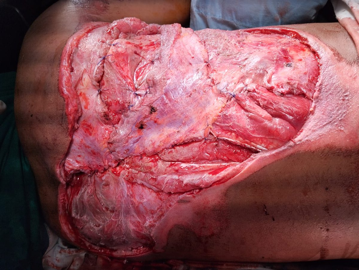 PunjabiScouser's tweet photo. Patient Sohail, 14/M
Case of Degloving injury + multiple posterior rib fractures with pleural breach. 
Pic 1. Preoperative picture
Pic 2. After debridement 
Pic 3. Final picture after LD flap, ipsilateral trapezius falp and contralateral spinalis flap
#MedTwitter #SU3 #AHFsd https://t.co/KfdmMkLSFd