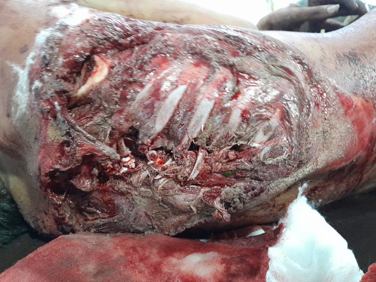PunjabiScouser's tweet photo. Patient Sohail, 14/M
Case of Degloving injury + multiple posterior rib fractures with pleural breach. 
Pic 1. Preoperative picture
Pic 2. After debridement 
Pic 3. Final picture after LD flap, ipsilateral trapezius falp and contralateral spinalis flap
#MedTwitter #SU3 #AHFsd https://t.co/KfdmMkLSFd