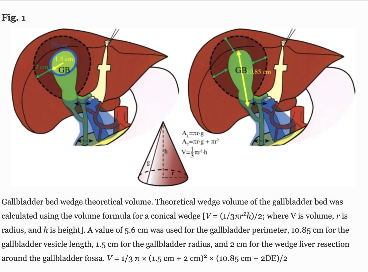 Annals of Surgical Oncology (@annsurgoncol) on Twitter photo OCTOBER ISSUE: Analysis of the Extent of Liver Oncological Extended Resection for #IncidentalGallbladderCancer: How Much Is Too Much? #liverresection rdcu.be/dph9C <a href="/SocSurgOnc/">Society of Surgical Oncology</a> OCTOBER ISSUE: Analysis of the Extent of Liver Oncological Extended Resection for #IncidentalGallbladderCancer: How Much Is Too Much? #liverresection rdcu.be/dph9C <a href="/SocSurgOnc/">Society of Surgical Oncology</a>