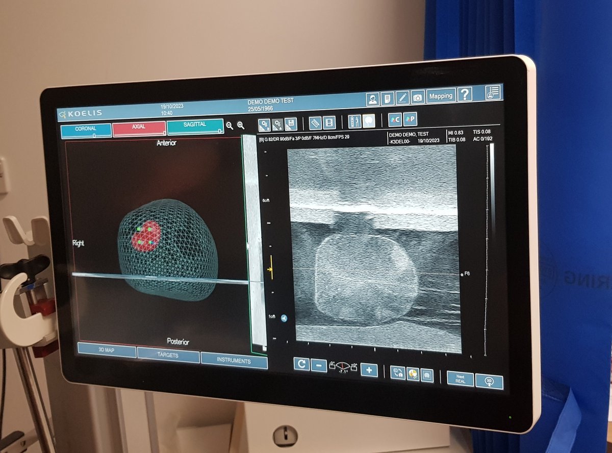 UrologyResearchNBT (@uroresearchnbt) on Twitter photo First patient to receive image fusion biopsy
<a href="/NorthBristolNHS/">North Bristol NHS Trust</a> for the <a href="/IP_London/">Imperial Prostate</a> PACIFIC trial: investigating improvements to prostate cancer diagnosis. Congratulations to Mr <a href="/stefbolomytis/">Stefanos Bolomytis</a> , the <a href="/bui_nbt/">NBT_BUI</a> team and @KoelisUk for all your support.
<a href="/imperialurology/">Imperial Urology</a> #urology First patient to receive image fusion biopsy
<a href="/NorthBristolNHS/">North Bristol NHS Trust</a> for the <a href="/IP_London/">Imperial Prostate</a> PACIFIC trial: investigating improvements to prostate cancer diagnosis. Congratulations to Mr <a href="/stefbolomytis/">Stefanos Bolomytis</a> , the <a href="/bui_nbt/">NBT_BUI</a> team and @KoelisUk for all your support.
<a href="/imperialurology/">Imperial Urology</a> #urology