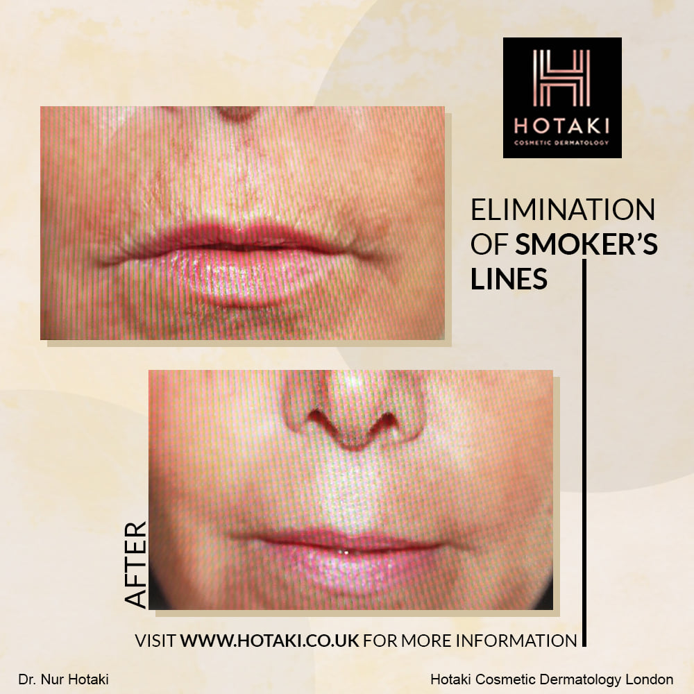 #DrHotaki #HotakiLondon #NonSurgicalAesthetics #AestheticTreatment #HotakiCosmeticDermatology #NonInvasive #NonSurgical #SmokersLines #Ageing #FineLines #Wrinkles