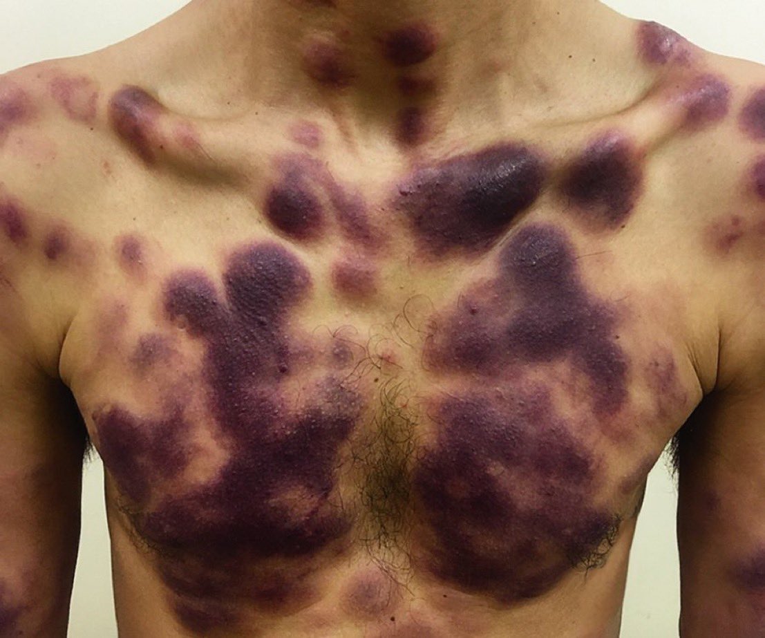 A 29 y.o. man with 6-month of painless, nonpruritic skin lesions on the face, back, trunk, limbs. He had no systemic symptoms. Skin biopsy: blast-like cells positive for CD4, CD56, and CD123.
- What's the diagnosis? @ManualOMedicine #MedEd #MedX