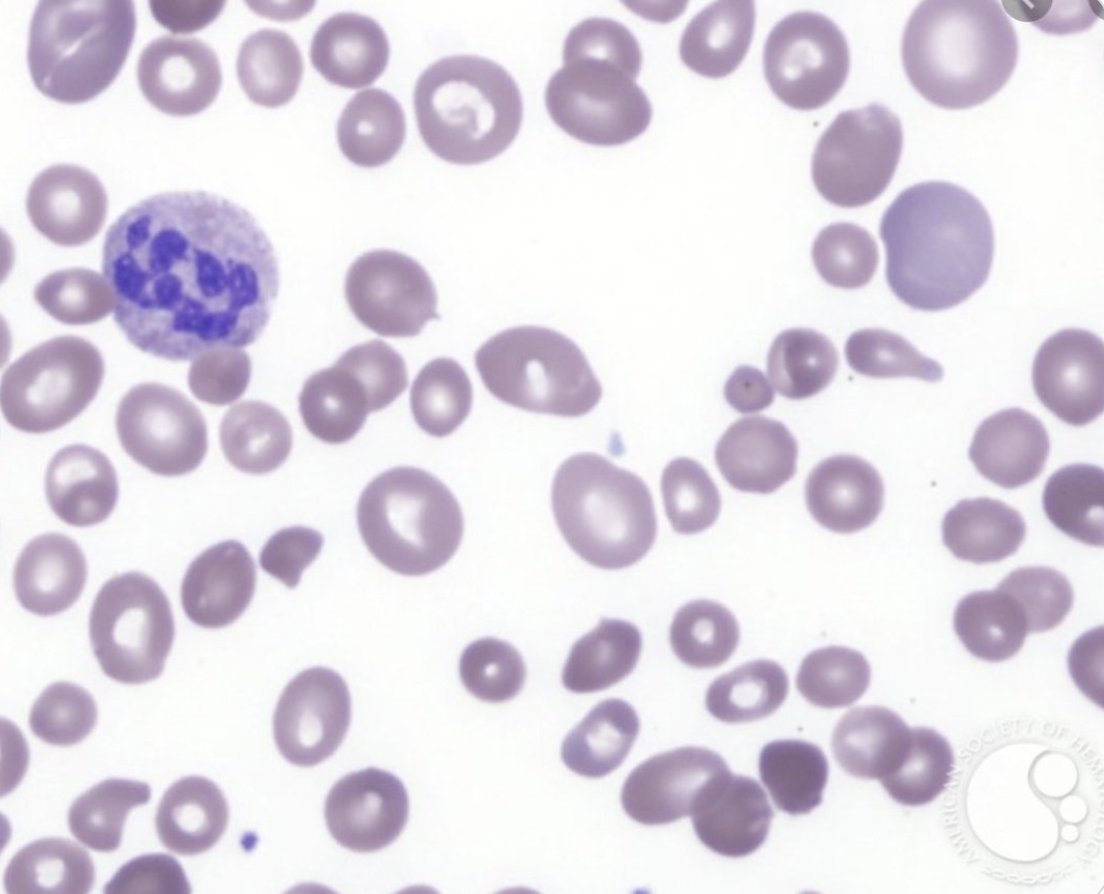 Big Blood - ABCDEGHs of Macrocytic Anemia A = Aplastic anemia (sometimes) B = B12⬇️ C = COPD D = Drugs (metformin), diphyllobothrium (tape worm) E = EtOH F = Folate G = Genetic (Diamond Blackfan) H = Hypothyroid, hepatic failure, hemolysis (retics are big) {ASH Image Bank}