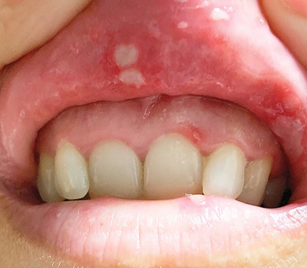 IhabFathiSulima's tweet photo. A 44-year-old woman with #Painful  recurrent #oral lesions.
What is the diagnosis ?
And Differential Diagnosis ? https://t.co/X4hknV8jhz