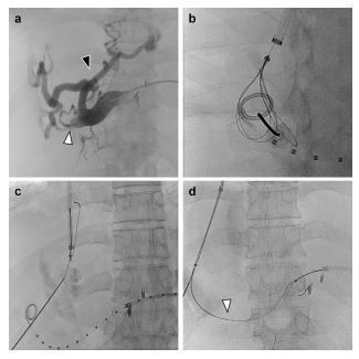 #shortcommunication 📖
Safety of #Percutaneous Transmesenteric and Transsplenic Access for Portosystemic Shunt Creation in Patients with Portal Vein Obstruction: Single-Center Experience and Review of Literature
link.springer.com/article/10.100…
#IRad