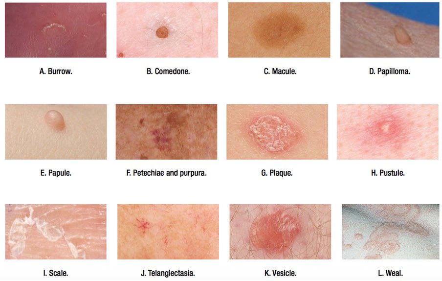 FosterDrugInfo's tweet image. ➤Types of #SKIN_LESIONS:

#Macular, #Pustule, #Wheal, #Papule, #Erosion, #Crust, #Nodule, #Scale, #Vesicle, #Fissure, #Scale, #Cyst, #Burrow, #Comedone, #Papilloma, #Plaque, #Petechiae and #Purpura.