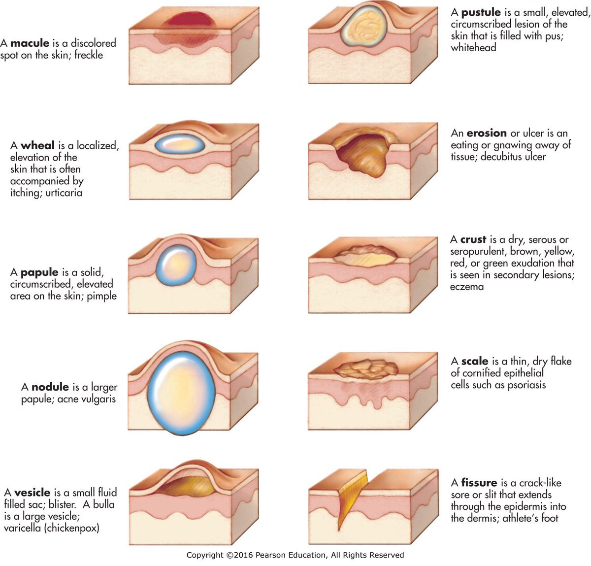 FosterDrugInfo's tweet image. ➤Types of #SKIN_LESIONS:

#Macular, #Pustule, #Wheal, #Papule, #Erosion, #Crust, #Nodule, #Scale, #Vesicle, #Fissure, #Scale, #Cyst, #Burrow, #Comedone, #Papilloma, #Plaque, #Petechiae and #Purpura.