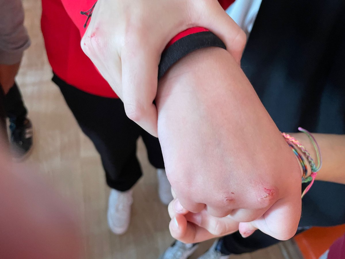 Sevgili ebeveynler, orta okul ve lise düzeyindeki çocuklar arasında, "Kanlı Para" adlı bir oyun oynanıyor. Çok ciddi ruhsal etkilerinin olmasının yanında, enfeksiyon riski de çok yüksek. Lütfen çocuklarınızın ellerine dikkat edin. Bu tarz yaralar görürseniz yardım alın.