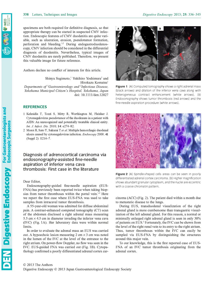 Diagnosis of adrenocortical carcinoma via endosonography-assisted fine-needle aspiration of inferior vena cava thrombosis: first case in the literature dlvr.it/SxtZgL