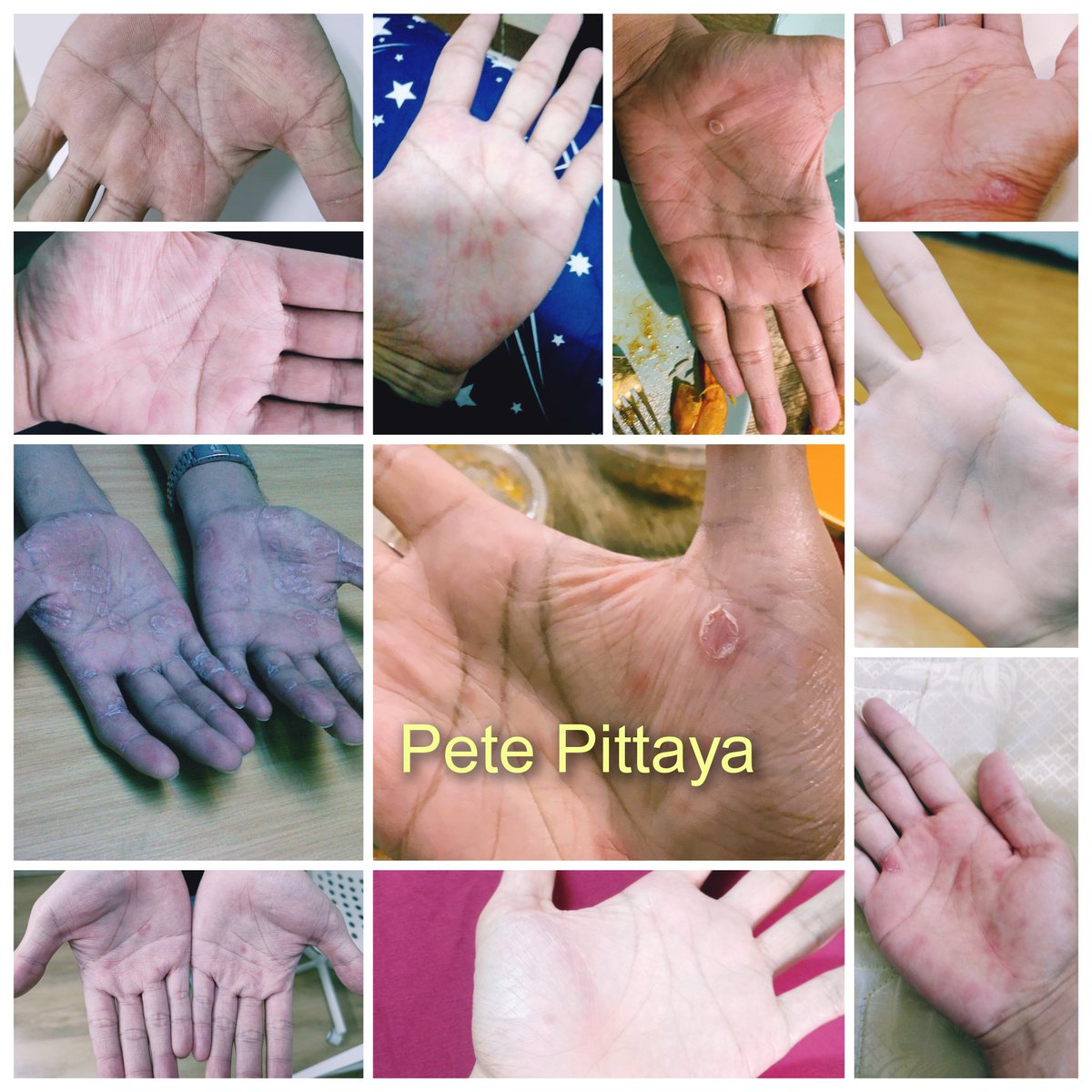 Pete Pittaya tweet media
