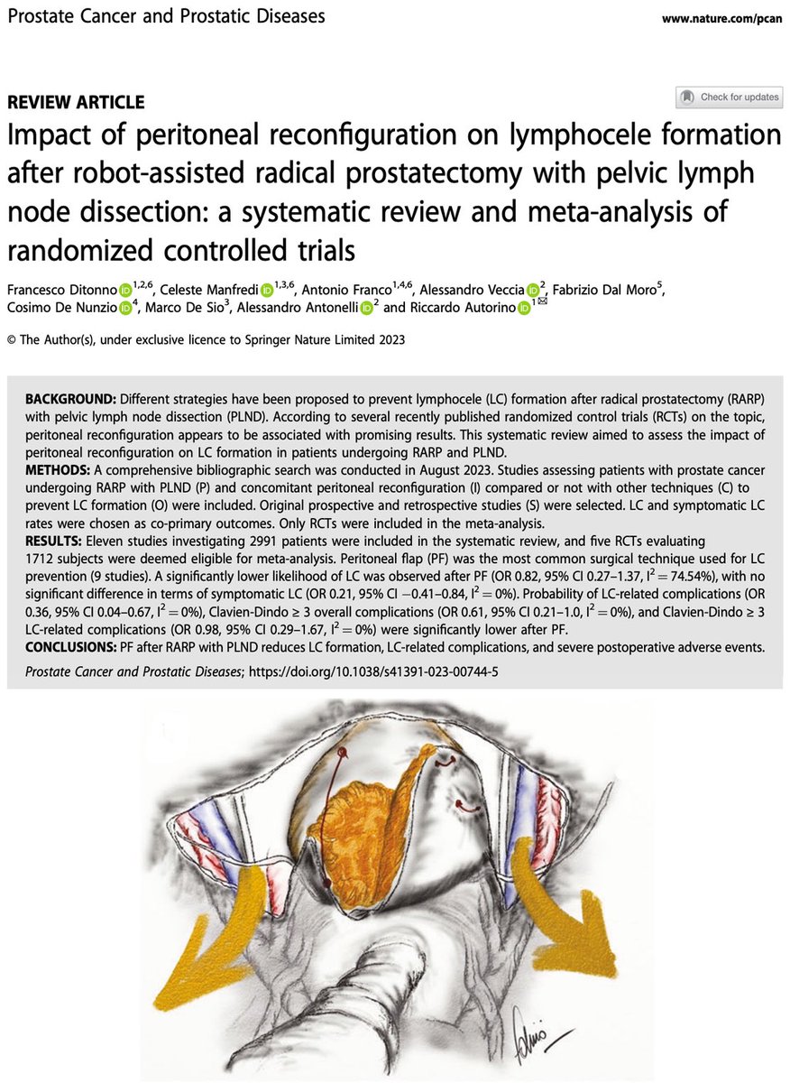 It is a pleasure to share the results of our latest meta-analysis of RCTs published on @pcan_journal. #PeritonealFlap after #RARP with #PLND reduces risk of #lymphocele, lymphocele-related complications and overall severe adverse events. Is it time to recommend this procedure?