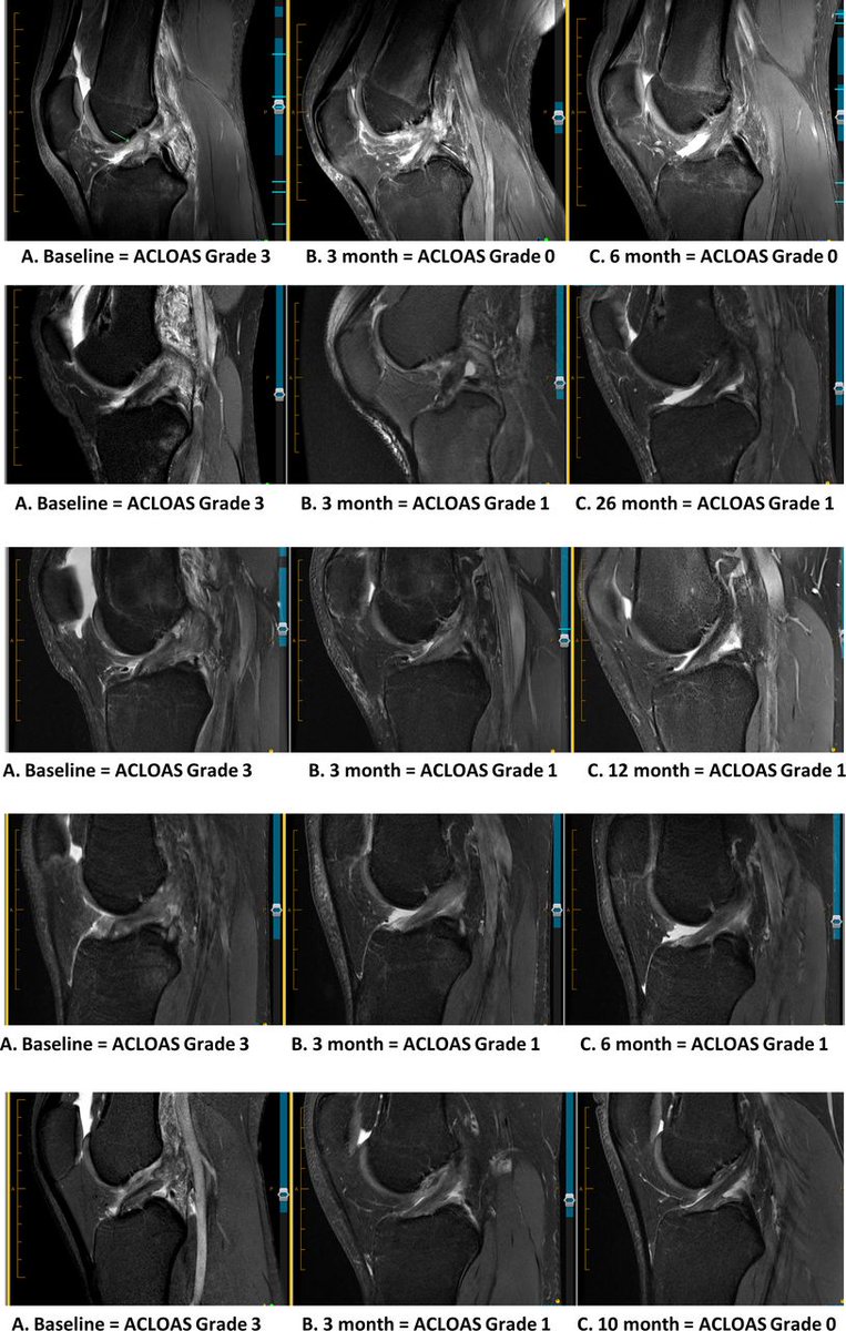 📣 #OriginalResearch 📄 90% patients with complete #ACL rupture showed signs of ACL continuity at 3 months on MRI when using the Cross Bracing Protocol This #OpenAccess article describes the impact this may have on future research and practice READ 👉 bit.ly/3qQAjbl