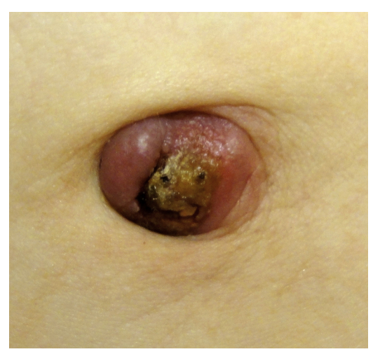 --What is the right diagnosis for this sign (umbilical lesion) and what are its main causes and prognosis ? #MedTwitter #Dermatology #Internalmedicine