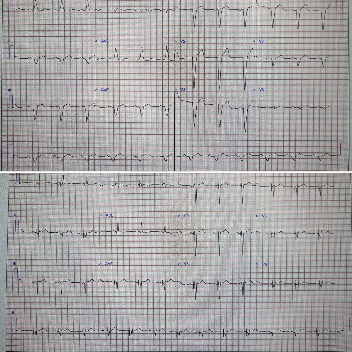 cardiochar's tweet photo. Another day, another narrow QRS 🤓
Top ➡️ Intrinsic LBBB 182ms
Bottom ➡️ AdaptivCRT (LV only) 98ms
6 months post implant + OMT:
• 84ms QRS reduction
• NYHA III ➡️ NYHA I
• Severe LV ➡️ Mildly impaired
#heartfailuremanagement #crtoptimisation #improvingHFRQOL https://t.co/3RCfb82iBX