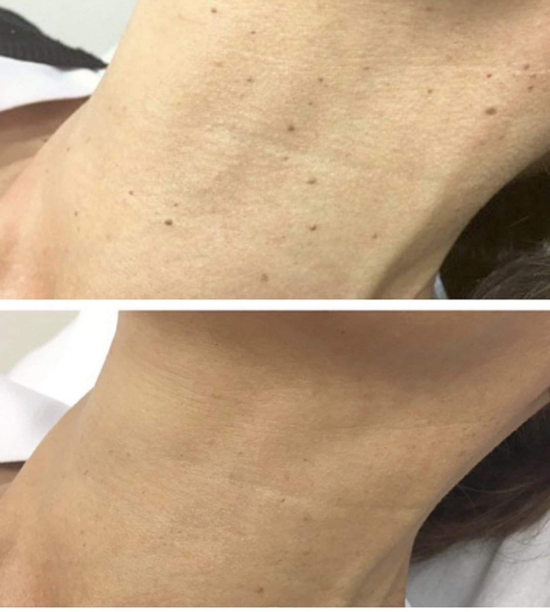 cb_aesthetics_'s tweet photo. Rebecca completed PTLLS at Chichester College and has used that knowledge to train experienced staff members across the country.

After working as a skin therapist for nearly 12 years, Becky expanded her knowledge in advanced cosmetic treatments and laser technology, treating a w https://t.co/FJ01XVRLW4
