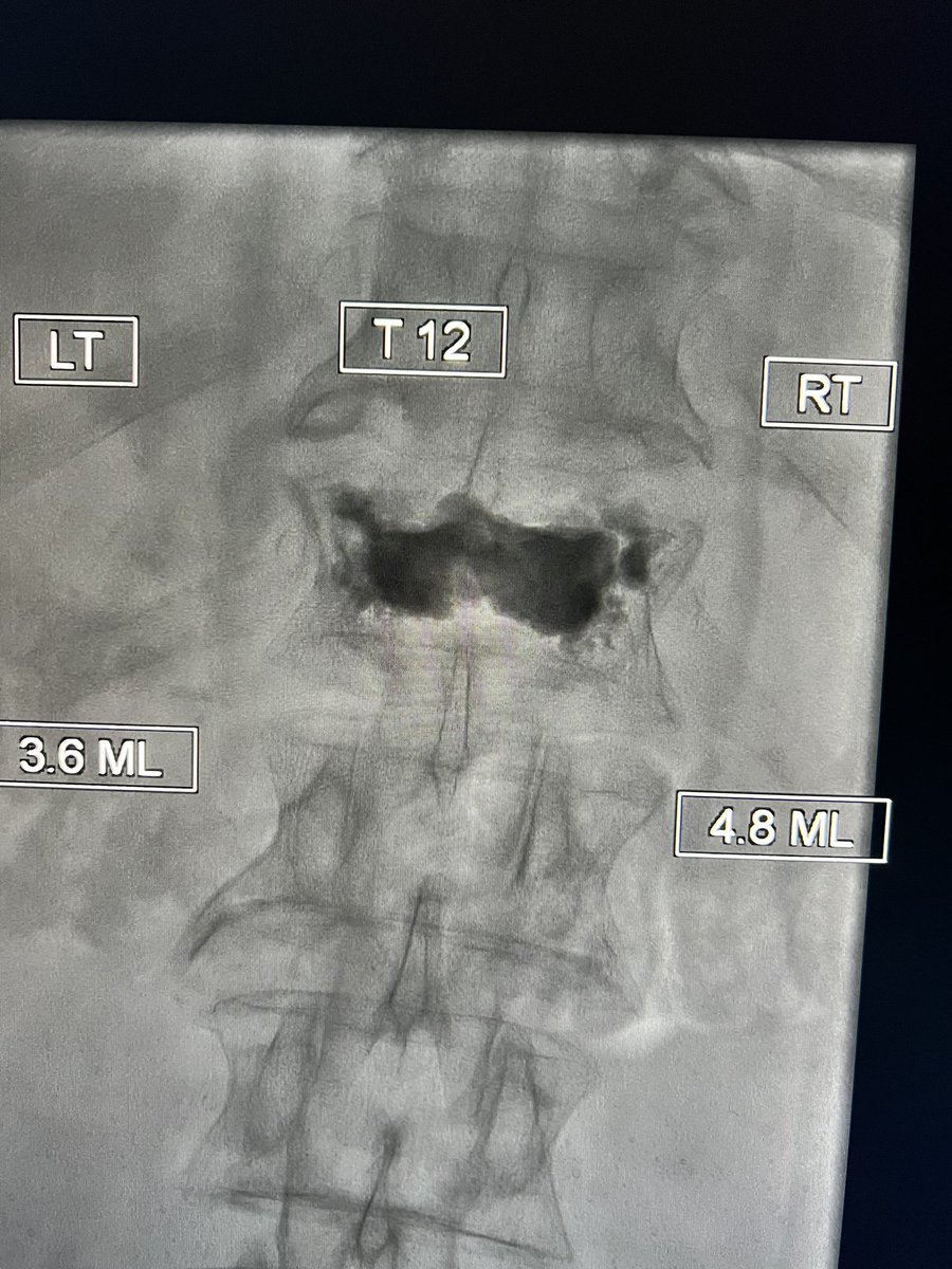 Kissing balloons and crossfill are always satisfying, patient with immediate improvement in back pain! #VIRad #MSKIR #pain #spine #WithoutAScalpel #medtwitter